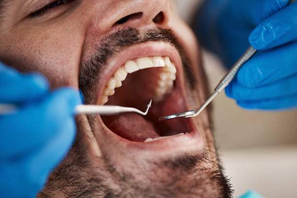 Best Emergency Dental Care for Broken or Chipped Teeth in Webster City, IA